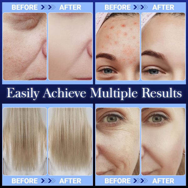 High Frequency Wand “C Blue Portable Skin Therapy Machine for Anti-Aging - Skin Tightening - Wrinkle Reducing - Dark Circles - 4 in 1