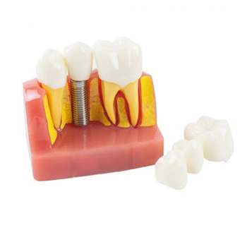 Dental Demonstration Teeth Model Implant Analysis Crown Bridge