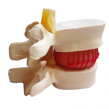 1:1.5 Medical Spine Lumbar Disc Herniation Model demonstration Model